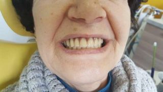 Smile after treatment with the new prosthesis