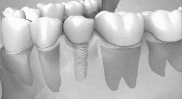 Inserare implant dentar