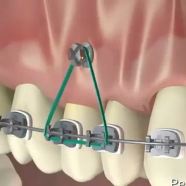 Mini implant ortodontic
