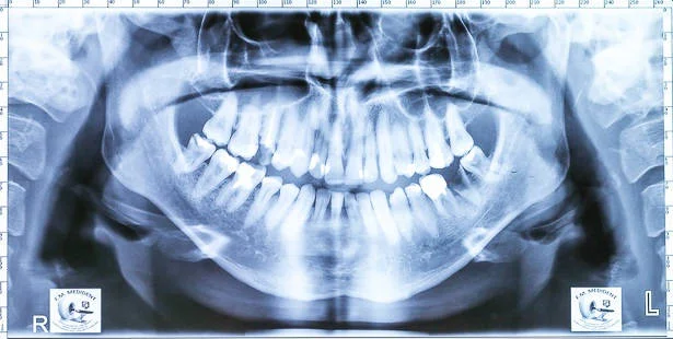 riscurile-implantului-dentar.jpg