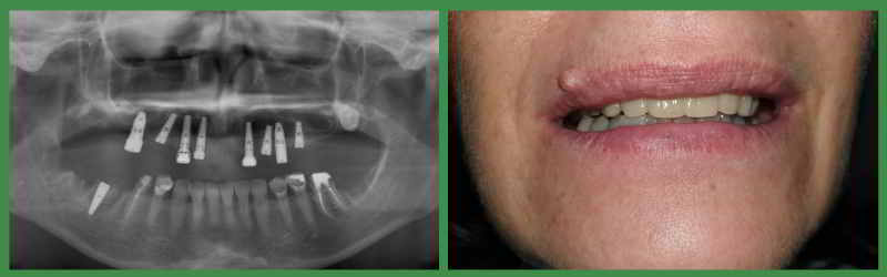 Radiography and dental situation after One by One implants
