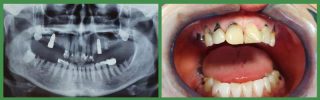 Radiography and dental situation before implants