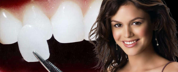Zirconium dental veneers