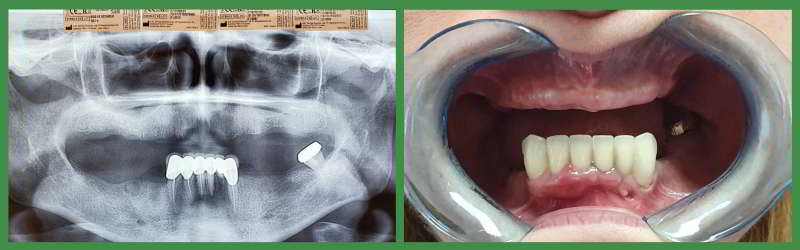 Radiography and initial dental situation