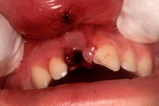 Avulsia dentara
