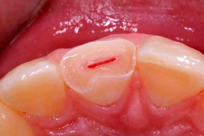 Fracture in enamel and dentin with pulp exposure