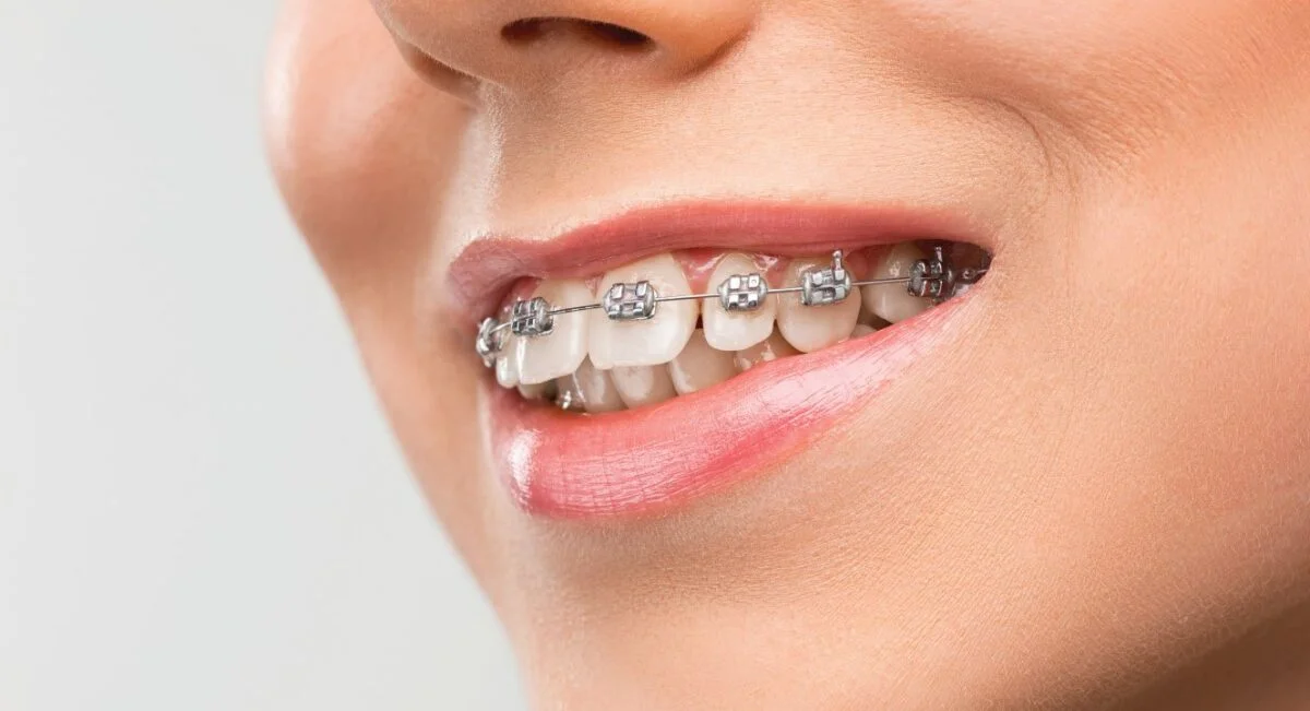 aparate-dentare-1200x651.jpg